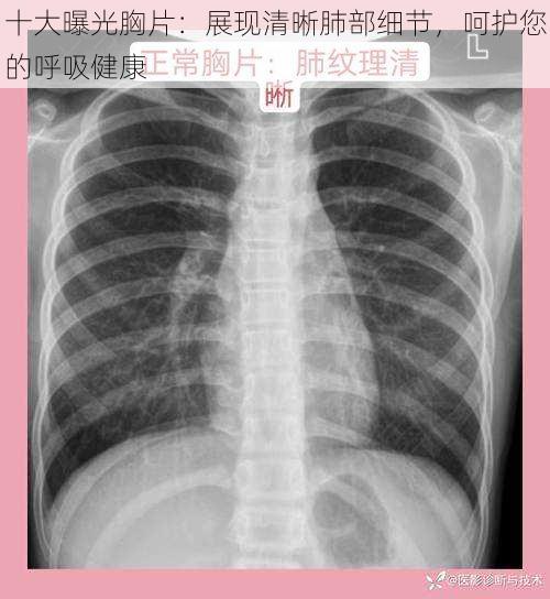 十大曝光胸片:展现清晰肺部细节,呵护您的呼吸健康