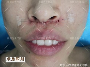 小嘴无力合拢红肿外翻，用[产品名称]，轻松解决